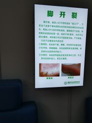 -德哥灰指甲脚气甲沟炎跖疣护理