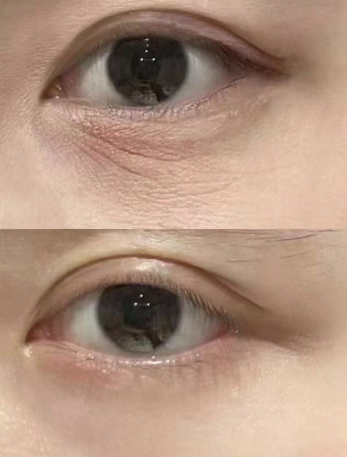 眼部抗衰对比图