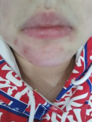 -痘瑞仕·专业祛痘国际连锁