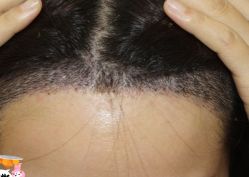 -大麦微针植发丨全国连锁