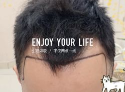 -大麦微针植发全国连锁