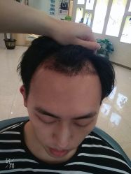 -大麦微针植发丨全国连锁