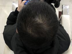 点击看大图 -大麦微针植发全国连锁