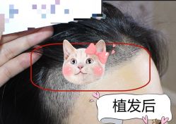-大麦微针植发全国连锁