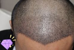 -大麦微针植发丨全国连锁