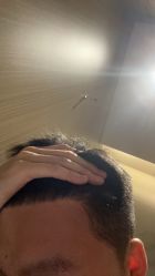 -大麦微针植发丨全国连锁