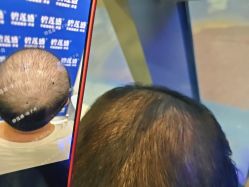 -碧莲盛·不剃发植发