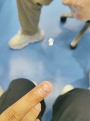 -足太医扦脚·灰指甲·嵌甲