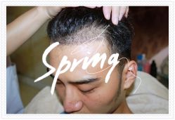 点击看大图 体验后-大麦微针植发全国连锁