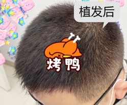 -大麦微针植发全国连锁