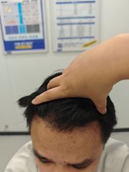 -大麦微针植发全国连锁