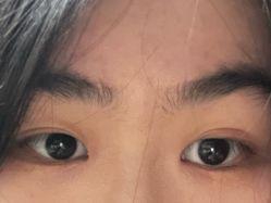 体验后-爱莎扁平疣·汗管瘤·斑痣中心
