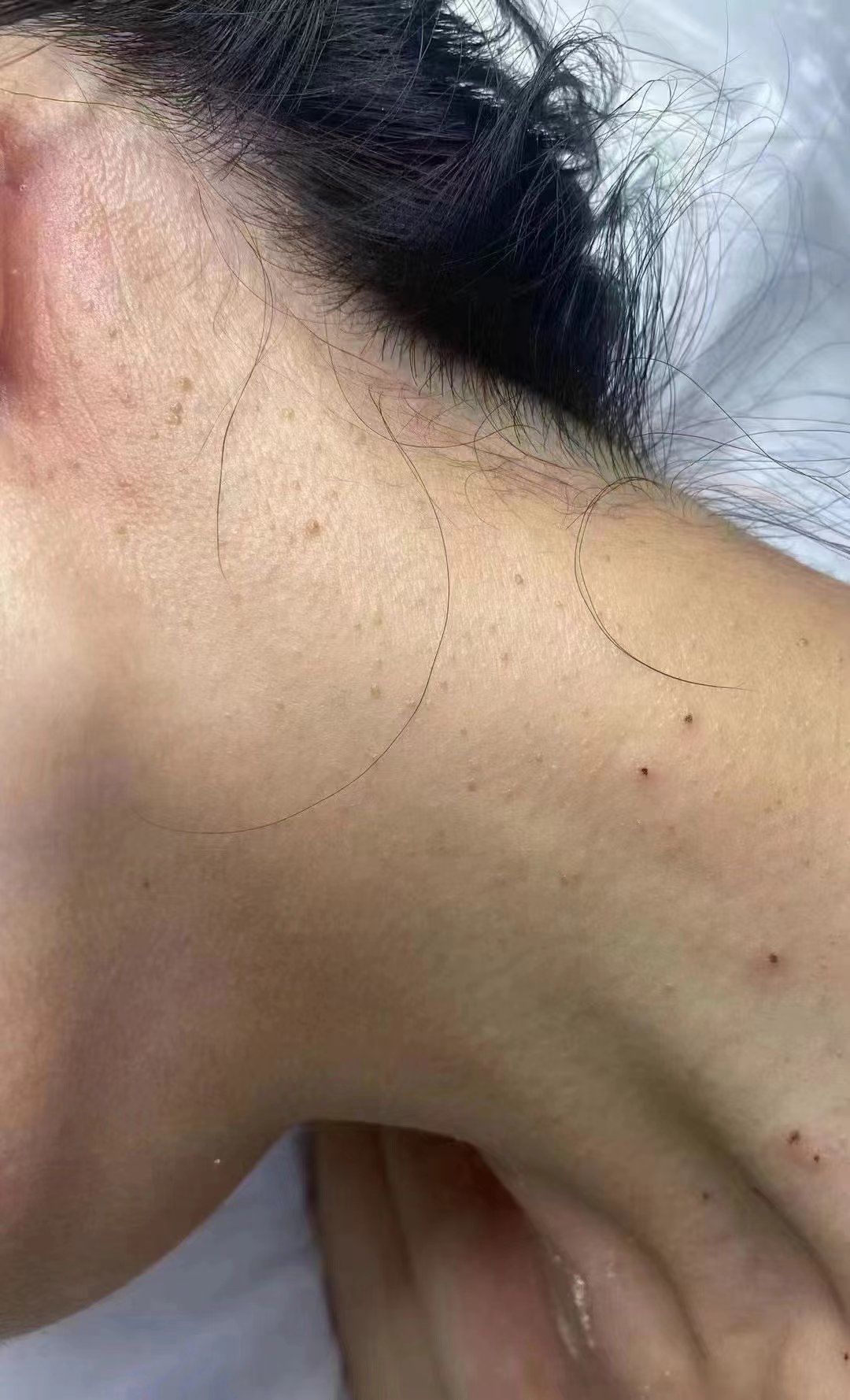 脖子上的"小肉揪"别忽视疣,别抠,越抠越