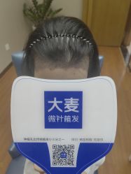 -大麦微针植发全国连锁