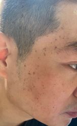 -爱莎扁平疣·汗管瘤·斑痣中心