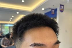 -大麦微针植发全国连锁