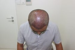 -大麦微针植发丨全国连锁