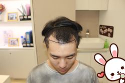 点击看大图 -大麦微针植发丨全国连锁