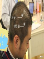 -大麦微针植发全国连锁