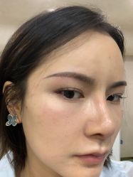 点击看大图 体验后-天津时光诺颜·轻医美·轮廓抗衰中心