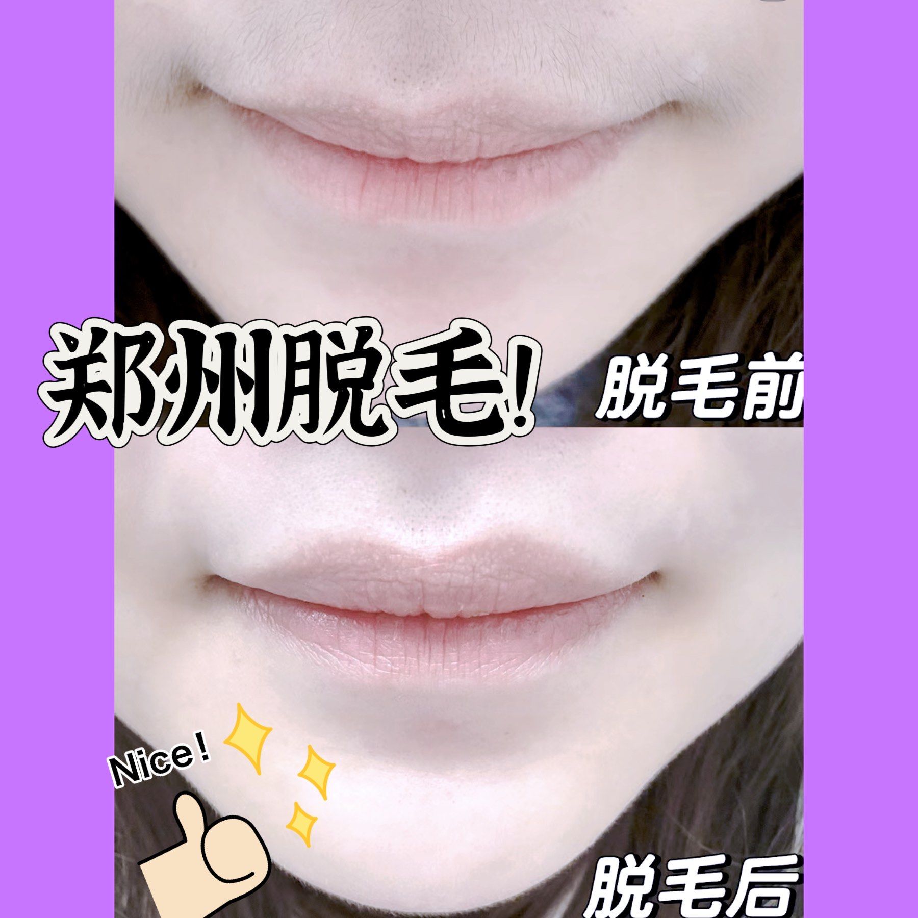 唇部脱毛效果对比90超干净[加油][加油][加油]