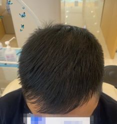 -大麦微针植发丨全国连锁