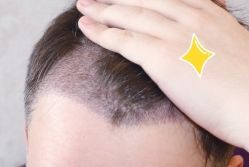 -大麦微针植发丨全国连锁