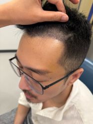 -大麦微针植发全国连锁