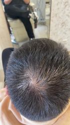体验后-大麦微针植发丨全国连锁