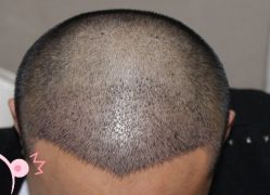 -大麦微针植发丨全国连锁