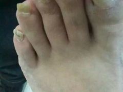 -祖传修脚甲沟炎灰指甲鸡眼