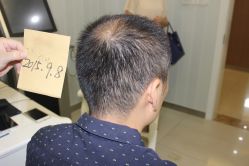 -大麦微针植发丨全国连锁