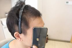 -大麦微针植发丨全国连锁