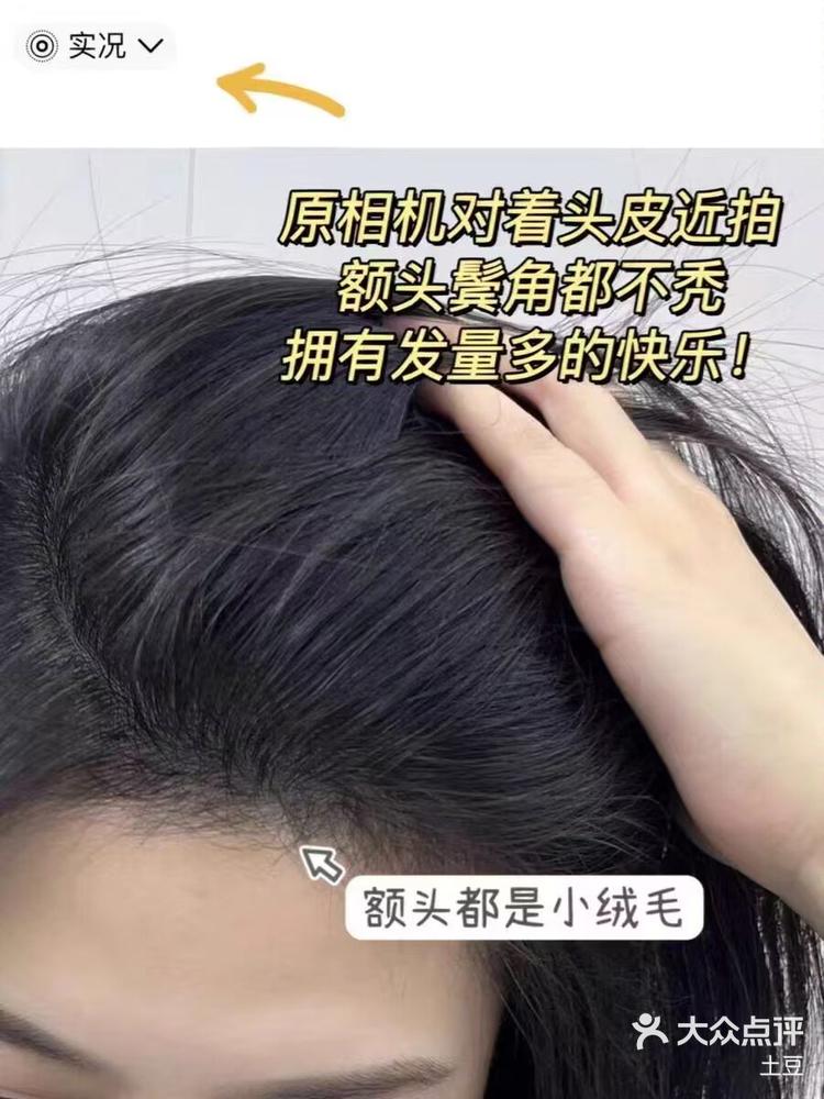 植发怎么保养补发(植发怎么保养补发效果好)