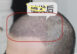 -大麦微针植发全国连锁