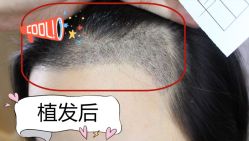 -大麦微针植发全国连锁