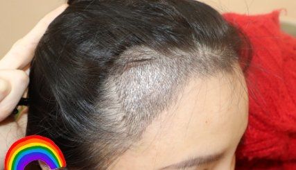 -大麦微针植发丨全国连锁