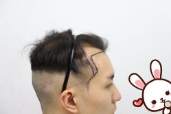 -大麦微针植发丨全国连锁