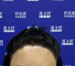 -碧莲盛·不剃发植发