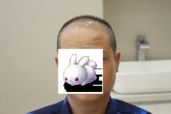 -大麦微针植发丨全国连锁