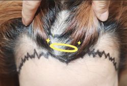 -大麦微针植发全国连锁