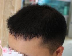 -大麦微针植发丨全国连锁