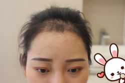 -大麦微针植发丨全国连锁