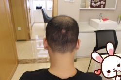 -大麦微针植发丨全国连锁