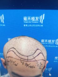 体验前-雍禾植发全国连锁