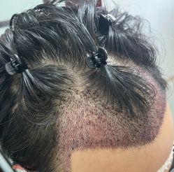 -大麦微针植发全国连锁