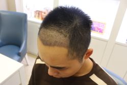 -大麦微针植发丨全国连锁