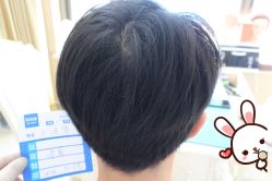 -大麦微针植发丨全国连锁