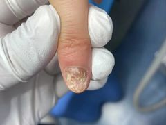 -Andrew指甲专科灰指甲·甲沟炎矫正·3D步态矫形鞋垫定制(上海法华镇路旗舰店)