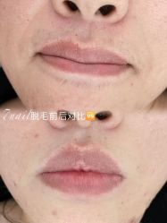 -小梨·OndaPro·专业脱毛连锁机构